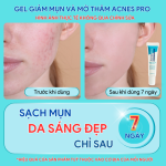 Tuýp Gel Acnes Pro Hỗ Trợ Mụn, Giảm Thâm, Phục Hồi Và Sáng Da Sau Mụn 20g